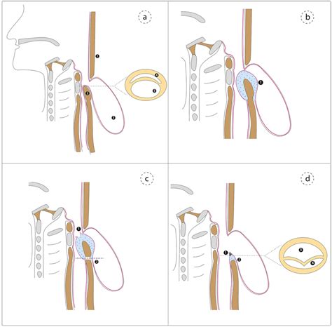 Schematic representation of the steps of D-POEM: a the anatomy of ...