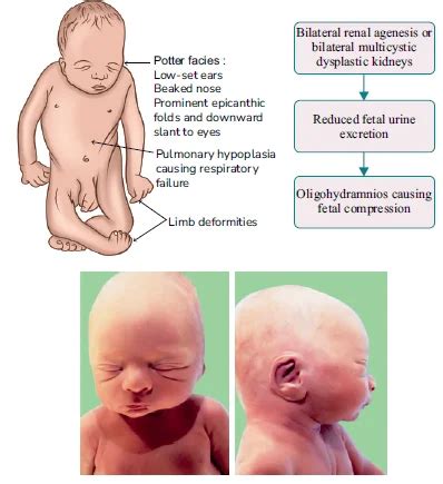 Congenital Anomalies of the Kidneys and Urinary Tract