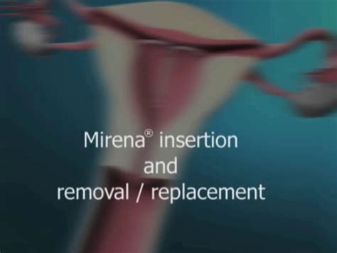 Mirena - Bayer on Vimeo