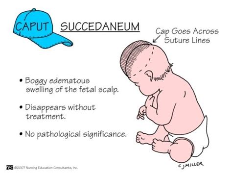 Caput Succedaneum #nursing | Child nursing, Nursing mnemonics, Neonatal ...