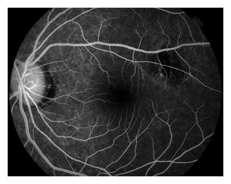 Fluorescein angiography (left eye). | Download Scientific Diagram