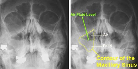 Imaging of Maxillary Sinusitis (Waters View, CT Scan, MRI ...