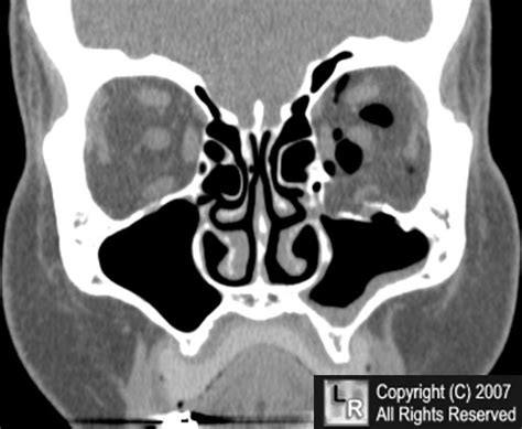 blowout fracture - meddic