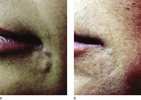 Avoidance and treatment of complications after dermal filler injections ...