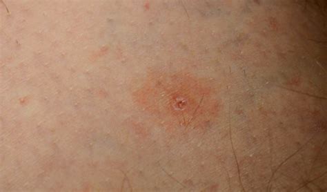 Tick Bite – Pictures, Symptoms, Causes, Treatment