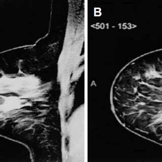 A: Intramammary lymph nodes affected by cancer metastases (3/3):... | Download Scientific Diagram