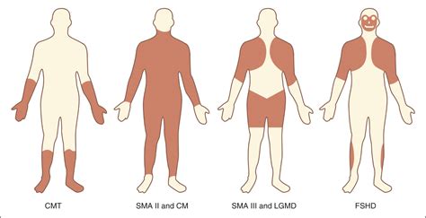 Peripheral Neuromuscular Diseases | Obgyn Key