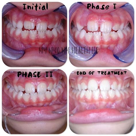 Before and After tongue thrust treatment myofunctional therapy