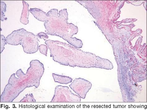 [PDF] Papillary Fibroelastoma Mimicking Vegetation of the Mitral Valve | Semantic Scholar