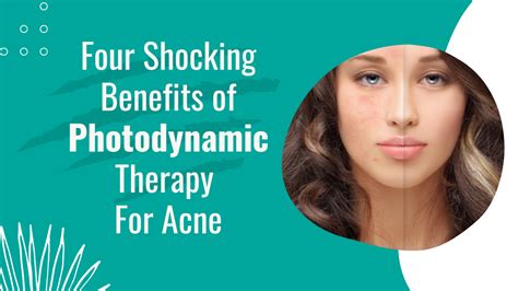 Photodynamic therapy for acne