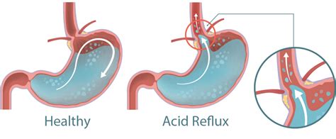 acid-reflux-vs-not-healthy