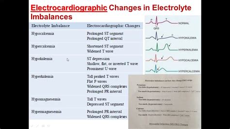 EKG Change in Electrolyte imbalance ECG changes associated with ...