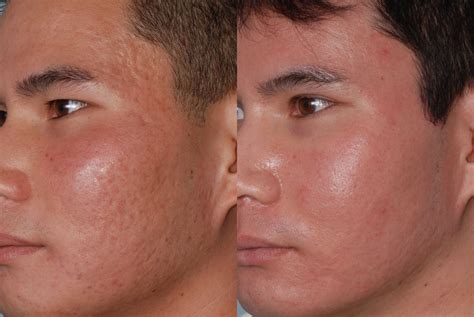 Pin on Acne Scar treatment with Taylor Liberator and Fraxel Reoair Laser, a One-and-Done ...