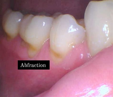 What Are Abfractions? | Dentist in Leesburg, VA