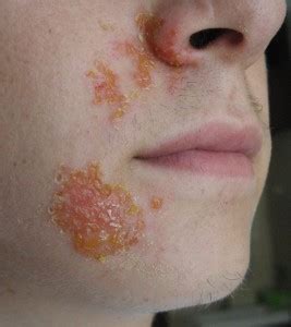 Impetigo or School Sores - Child Health