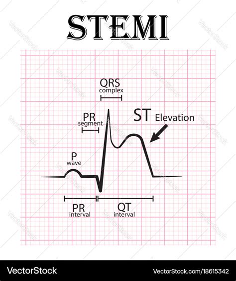 Ecg of st elevation myocardial infarction stemi Vector Image