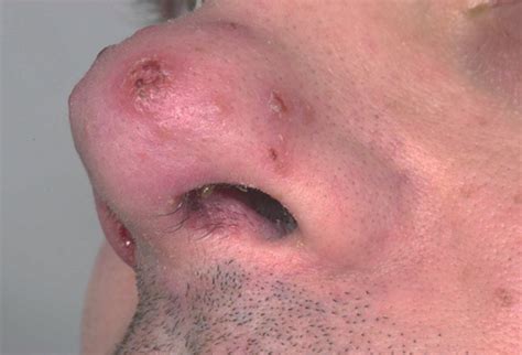 Mucocutaneous leishmaniasis: an imported infection among travellers to ...