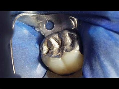 Amalgam filling procedure - YouTube