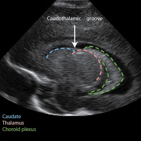 Ventricles - Anatomy - Caudothalamic Groove - located between the caudate nucleus and thalamus ...