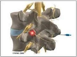 Facet Joint Denervation in Jaipur by Gaurav Sharma | ID: 7132727030