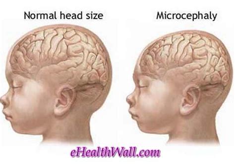 Microcephaly - Pictures, Definition, Causes, Life Expectancy, Prognosis