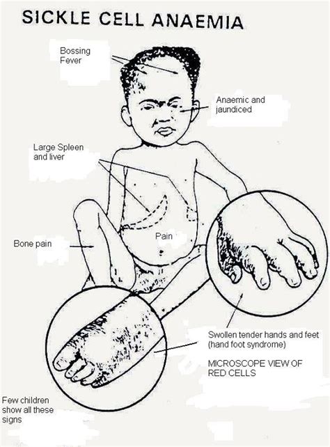 Sickle Cell Anemia Symptoms