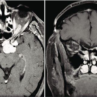 (PDF) Optic nerve sheath meningioma: Current diagnosis and treatment