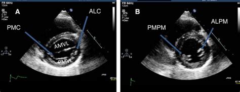 Parasternal short axis views. (A) At the level of mitral valve showing ...