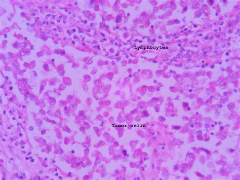 Seminoma – Histopathology.guru