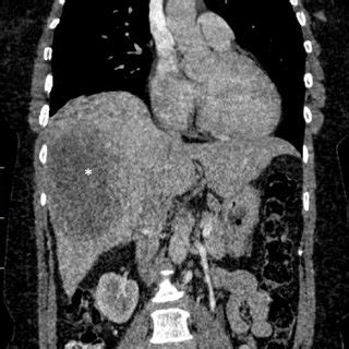 Axial views of a contrast enhanced CT scan of the liver revealing a... | Download Scientific Diagram