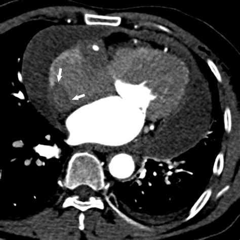 A contrast-enhanced computed tomography image demonstrating an... | Download Scientific Diagram