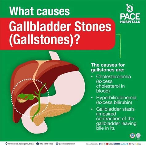 Gallstone Dissolving Medication | saenzvalienteblog.com.ar