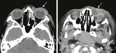 Orbital Septum Radiology