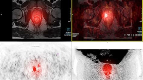 Posluma Approved for PET Imaging in Prostate Cancer | Frank Herd