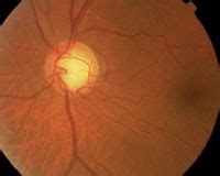 Cup-to-disc ratio not crucial to glaucoma documentation