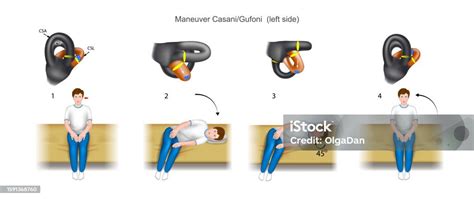 Maneuver Casani Gufoni Left Side Stock Illustration - Download Image Now - Dizzy, Vertigo ...