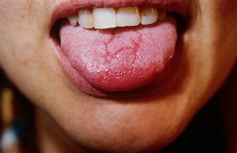 Geographic Tongue: 10 Causes of Geographic Tongue