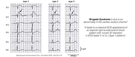 Brugada Syndrome Ekg Findings - Captions Hunter