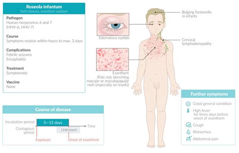 Interesting MediCine 🤩🩺 on Twitter: "@saad_iq64 🥵(roseola infantum, exanthema subitum, or sixth ...