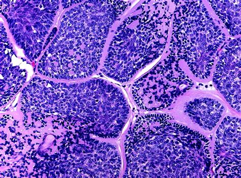 Dermal cylindroma - Libre Pathology