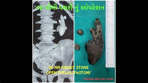 Left open Pyelolithotomy for 90 mm Kidney Stone - YouTube