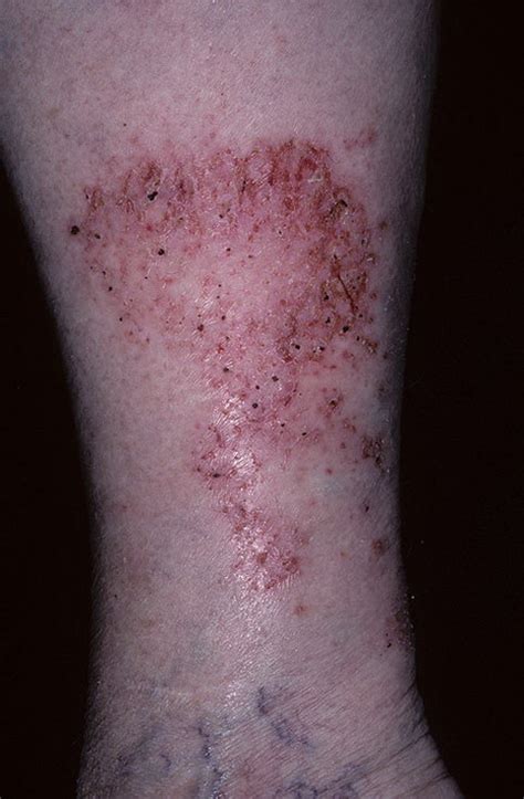 Stasis Dermatitis on Legs Pictures – 174 Photos & Images / illnessee.com