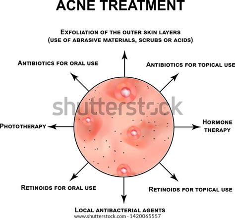 Acne Treatment Pustules Papules Comedones Blackheads Stock Vector (Royalty Free) 1420065557