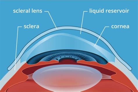 Scleral Lenses | New Braunfels Vision Center