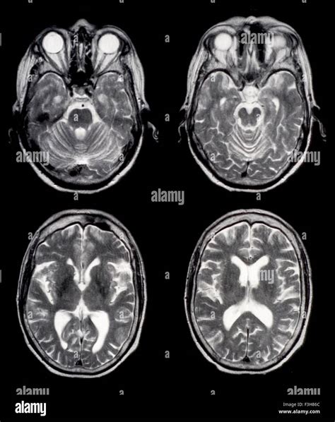 Axial brain MRI images Stock Photo - Alamy