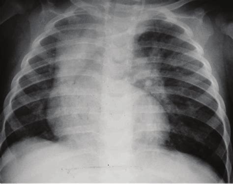 Chest X-ray showing hyperinflation of the left upper lobe, with... | Download Scientific Diagram