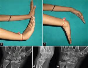 Synovitis of the wrist joint caused by an intraarticular perforation of an osteoid osteoma of ...