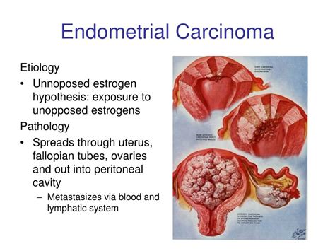 PPT - Endometrial Cancer PowerPoint Presentation, free download - ID:221956