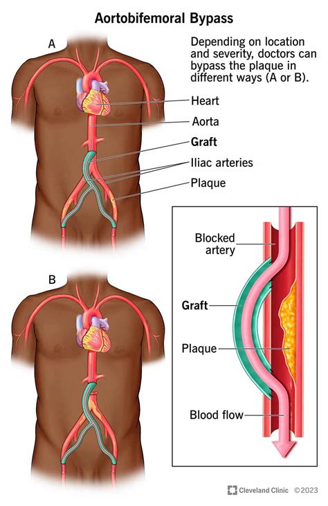 Aortobifemoral Bypass Surgery: What It Is & Procedure Details