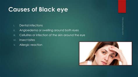 PPT - Treatment of Dark/black Circles Around Eyes at Home PowerPoint ...